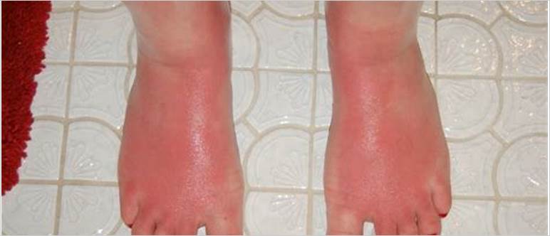 Sunburned swollen feet